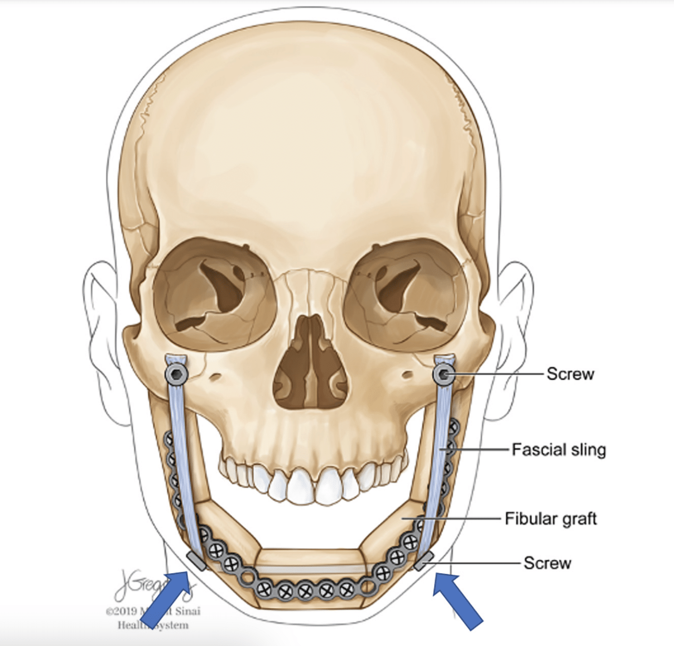 A novel technique to prevent or correct open-mouth deformity after